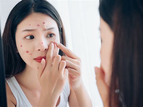 痣的種類|痣 – Hong Kong College of Dermatologists (HKCD)